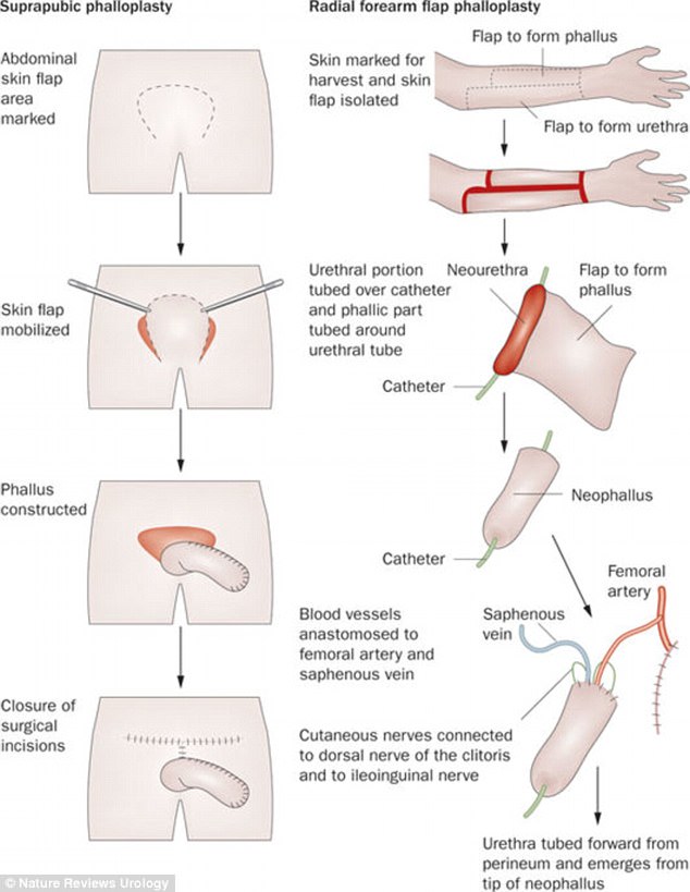 Transition: When a trans man decides to undergo sex change surgery, there are different options for him to choose from, however some opt not to have a surgical procedure