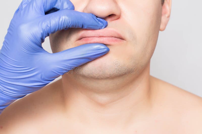 Doctor plastic surgeon examines the lips of a male patient. The concept of changing the shape and size of lips in men, asymmetry. Doctor plastic surgeon examines royalty free stock photography