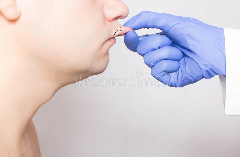 Doctor plastic surgeon examines the lips of a male patient. The concept of changing the shape and size of lips in men, asymmetry. Doctor plastic surgeon examines stock photos
