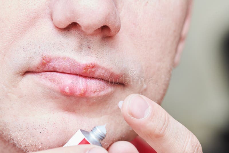 Herpes simplex virus infection. Lips treatment by cream. Male face. Herpes virus on male lips. medical treatment by ointment. Man smearing sore with cream royalty free stock photos