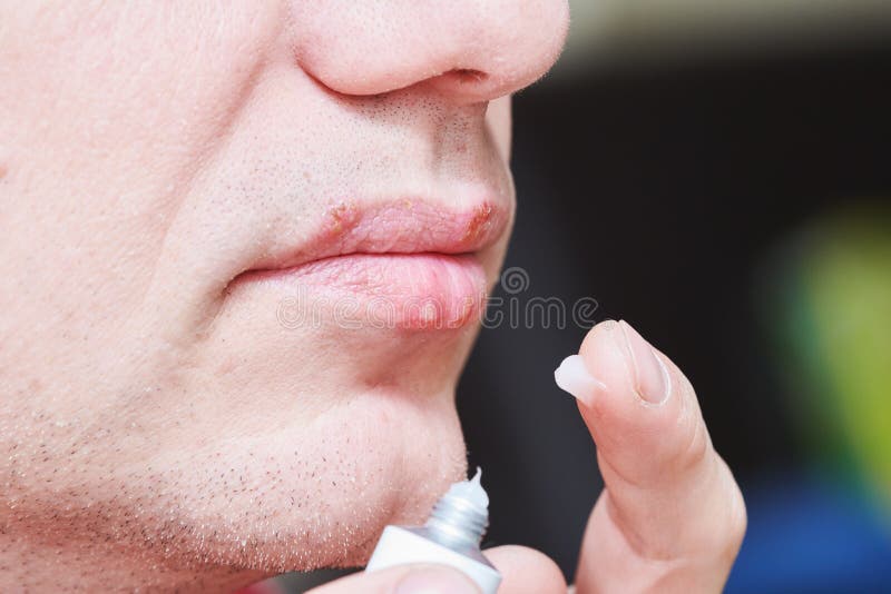 Herpes simplex virus infection. Lips treatment by cream. Male face. Herpes virus on male lips. medical treatment by ointment. Man smearing sore with cream stock images