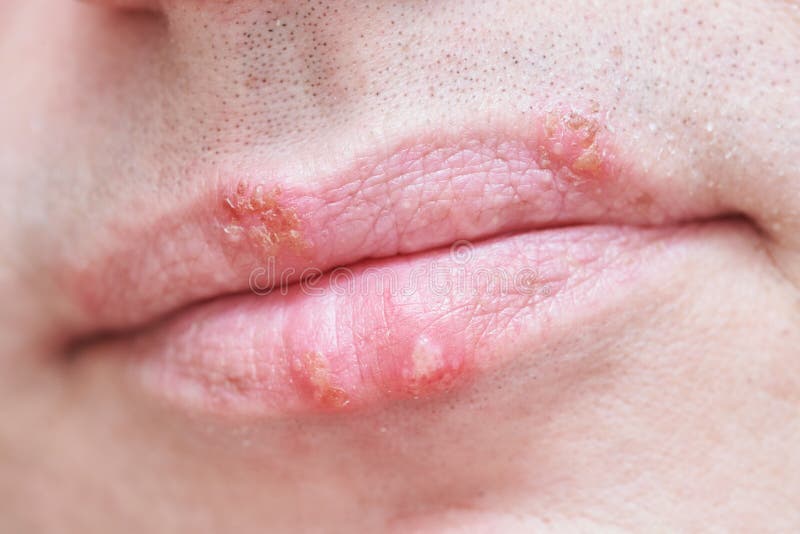 Herpes simplex virus infection on male face lips. Herpes virus on male face lips. Man with hsv infection on lips stock photo