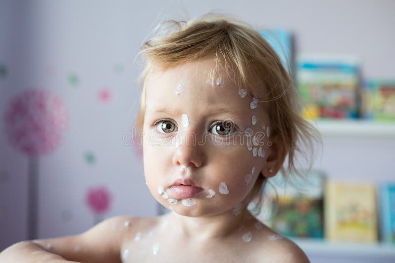 Little girl with chickenpox, antiseptic cream applied to the rash stock photo